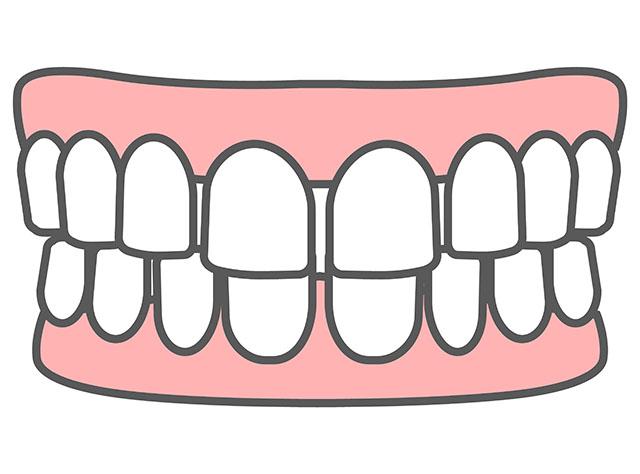 空隙歯列の治療について