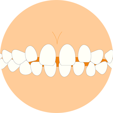 歯と歯の間が広くあいている（すきっ歯）